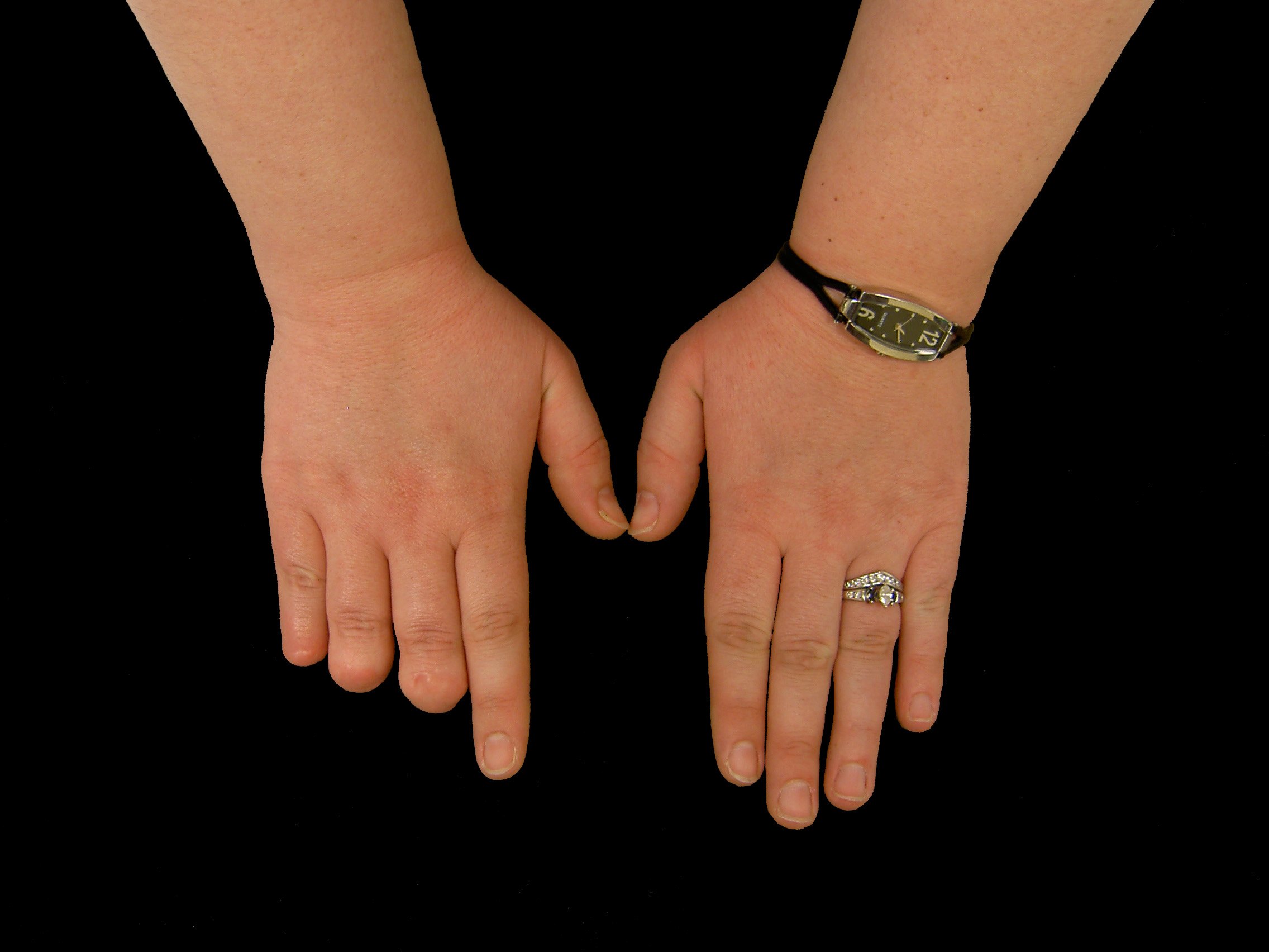 Женщины без пальцев на руках